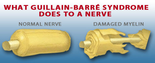 Guillain-Barre Syndrome