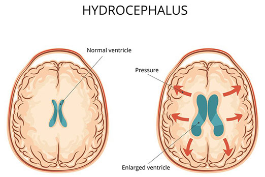 Hydrocephalus