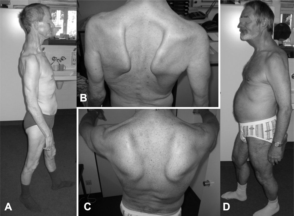 Myopathy