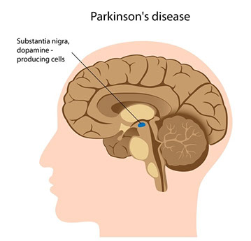 PARKINSON'S DISEASE
