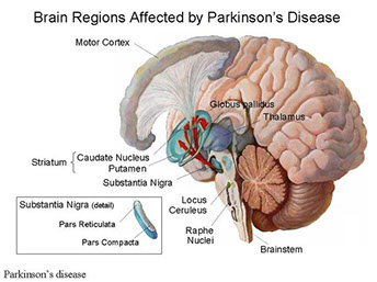 Parkinson’s Disease – sripadmavathihospital.com